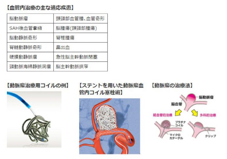 血管内治療 図