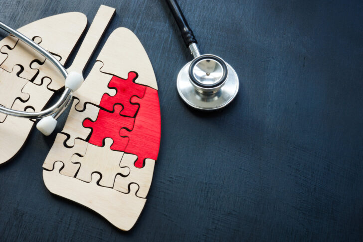 間質性肺炎の治療方法とは?治療の流れや症状についても解説