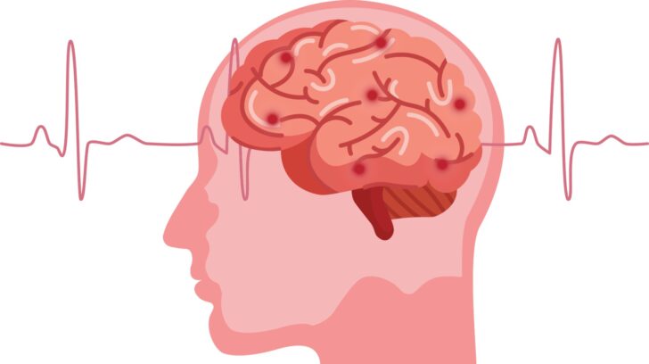 脳腫瘍を引き起こすと考えられる2つの原因