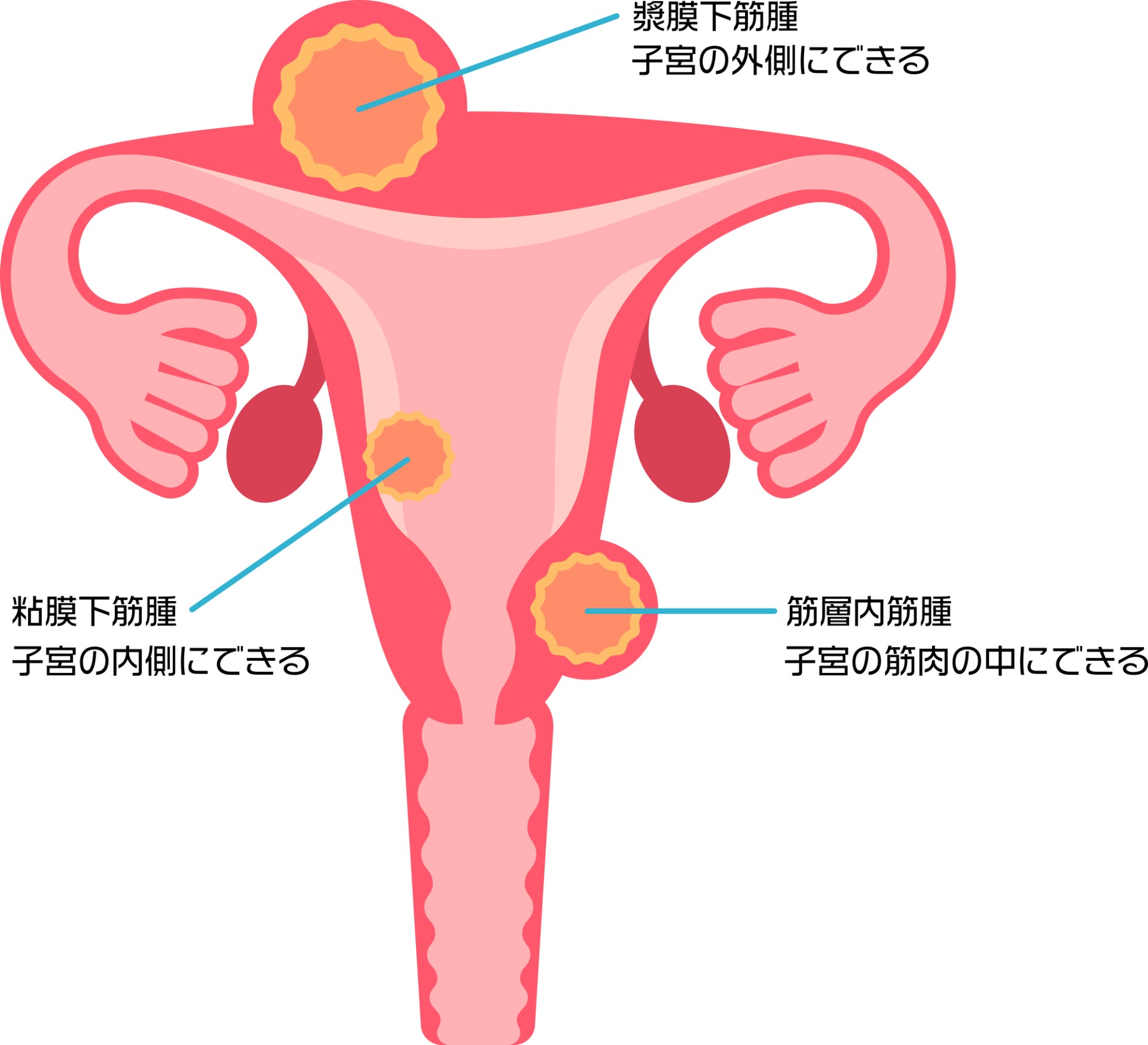 子宮筋腫とは