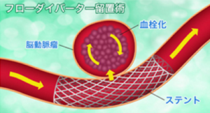 瘤内への血流を減らし、動脈瘤を血栓化させて破裂を防ぎ、治癒させます。